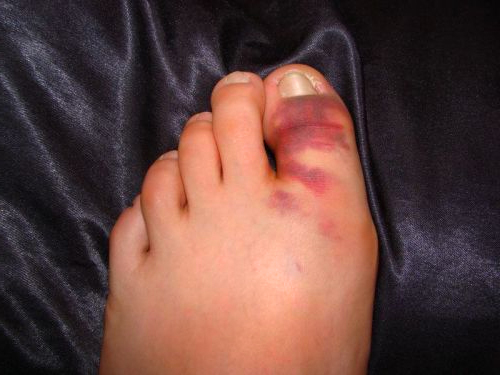Перелом пальца на ноге и его симптомы