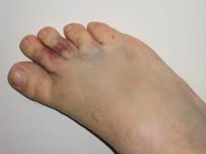 Перелом безымянного пальца на ноге