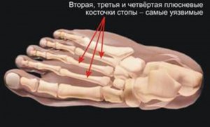 перелом пальцев стопы