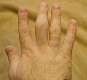 Симптомы перелома пальца