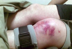Виды переломов коленного сустава