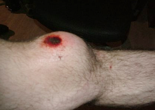 Перелом надколенника(коленной чашечки) и его лечение
