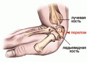 Механизм перелома ладьевидной кости руки