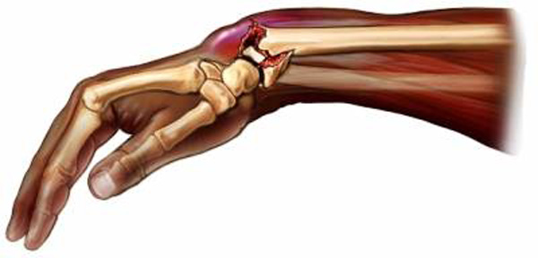 Переломы ладьевидной кости руки и стопы - симптоматика и лечение