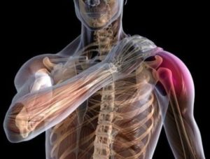 Признаки и симптомы вывиха плечевого сустава