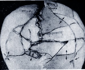 оскольчатый перелом черепа