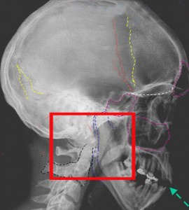 Описание черепа дырчатый перелом thumbnail