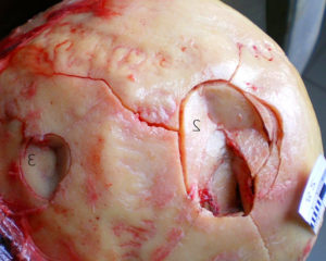 Описание оскольчатого перелома черепа thumbnail