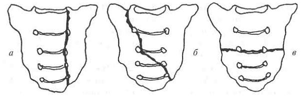 Виды переломов крестца