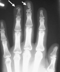 Перелом фаланги пальца руки симптомы
