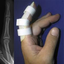 Указательный палец перелом фаланги